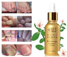 Fungal Nail ToenailsTreatment TCM Essence Oil Hand and Foot Whitening Removal Nail fungus Feet Care Nail