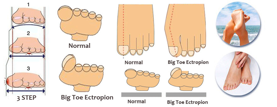 2pcsPair Silicone Gel foot fingers Two Toe Separator thumb valgus protector Bunion adjuster Hallux Valgus Guard feet care (5).jpg