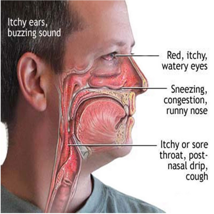 sinus runny nose