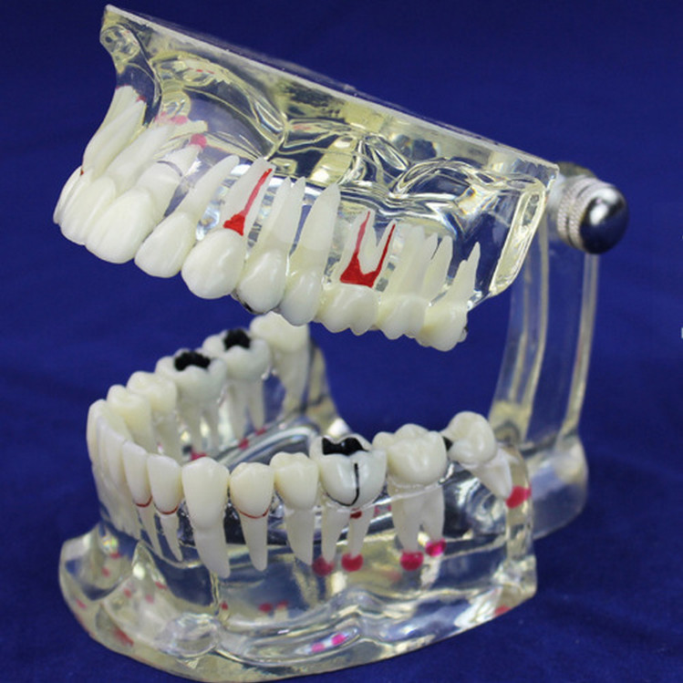 2015 Dental Implant Disease Teeth Model with Restoration Bridge Tooth Dentist for Medical Science Teaching
